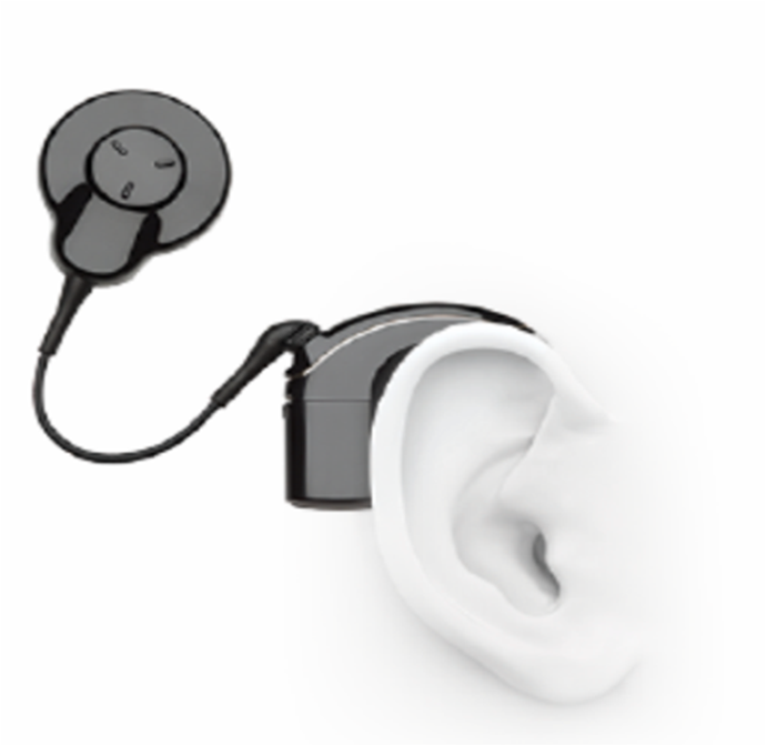 vshearing-cochlear