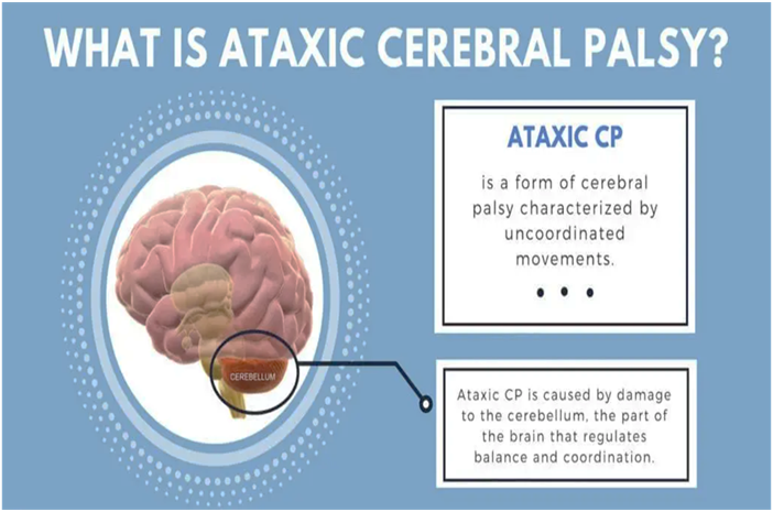 Ataxic Cerebral Palsy
