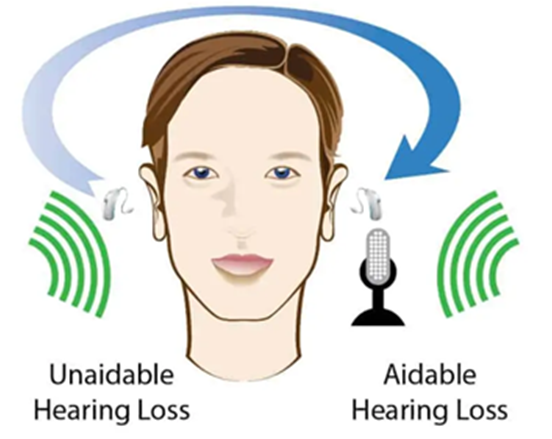 BICROS Hearing Aids