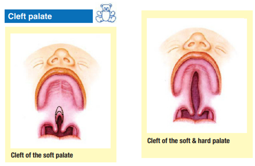 Cleft of Palate 