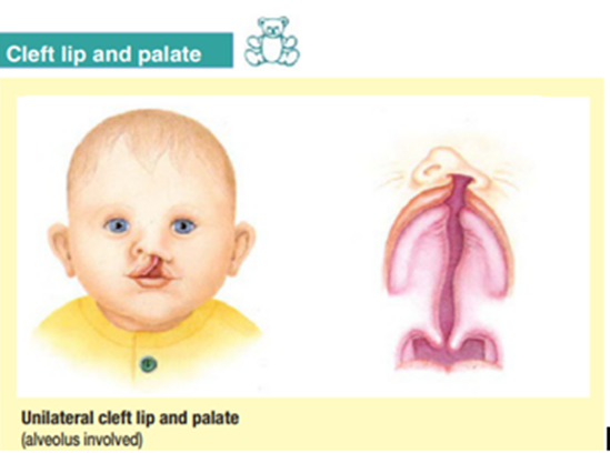 Cleft Lip & Palate