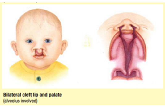 Cleft Lip & Palate
