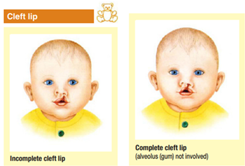 Cleft of Lips 