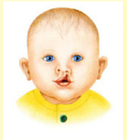 Cleft Lip & Palate 